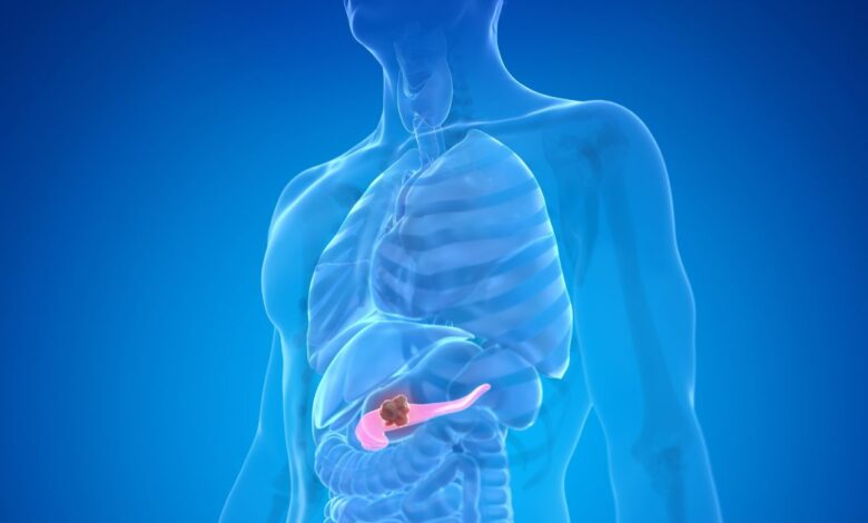“Gana seis meses de vida”… Medicamento contra el cáncer de páncreas da esperanza para otros cánceres “Gana seis meses de vida”… Medicamento contra el cáncer de páncreas da esperanza para otros cánceres